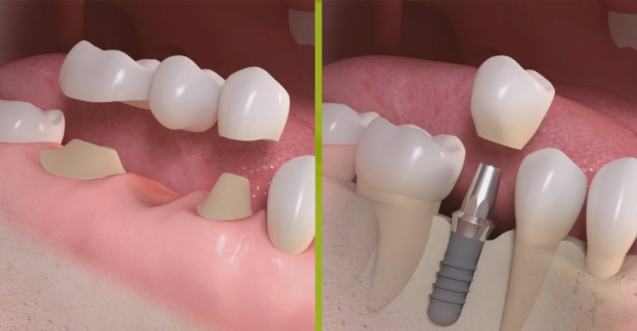 Approfondimento sull’implantologia dentale