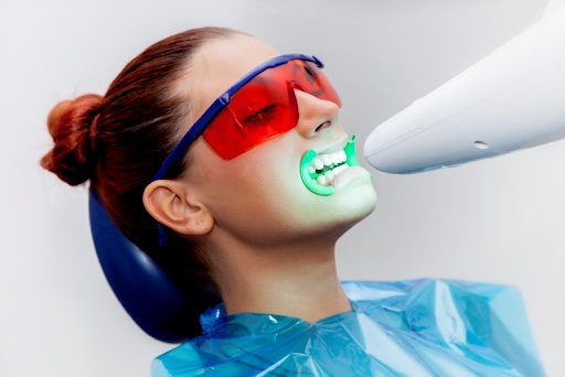 SBIANCAMENTO – Trattamento dentale per denti più bianchi