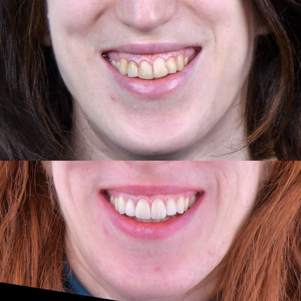 Faccette per denti disallineati