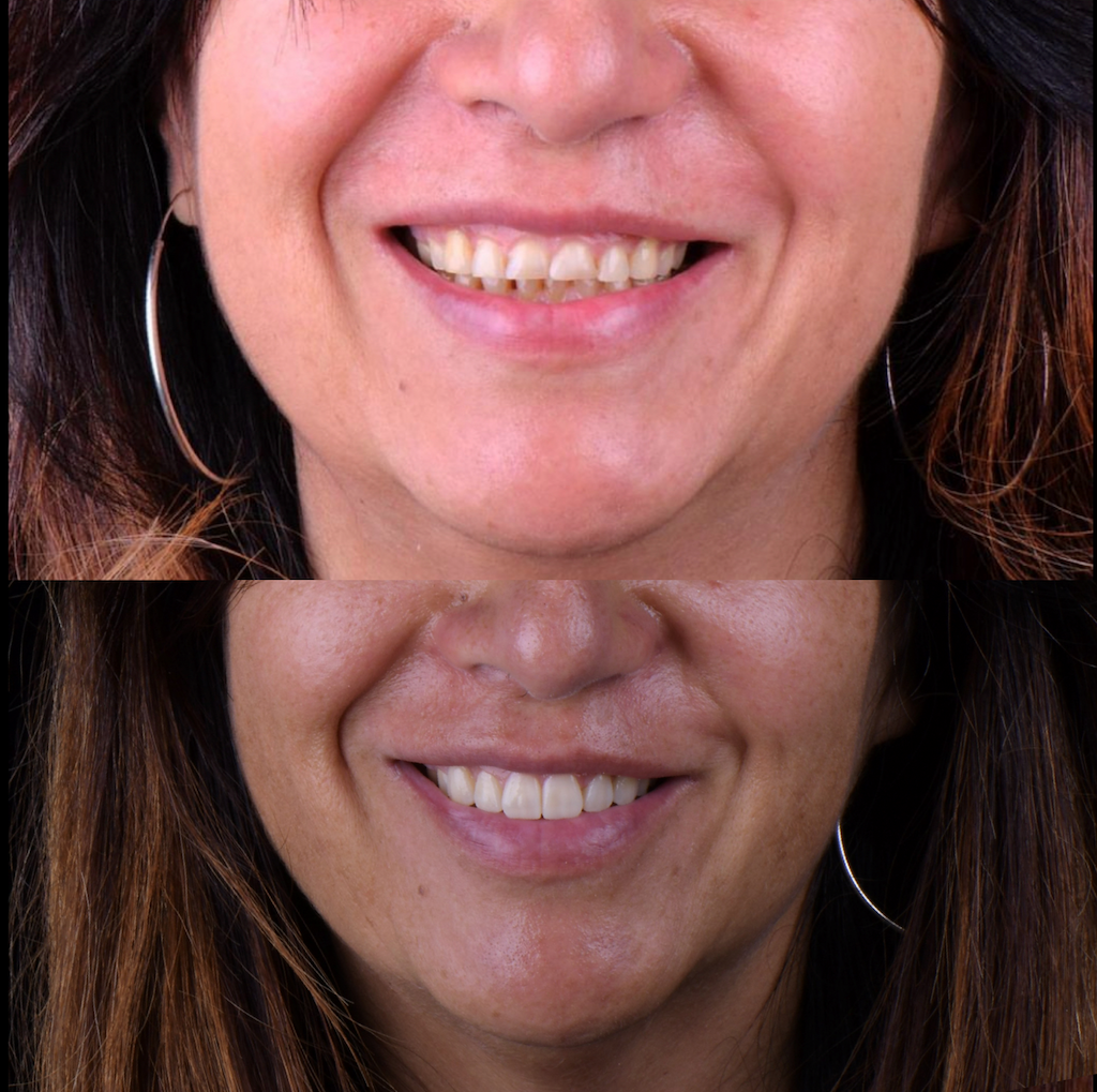 Faccette per denti abrasi e consumati
